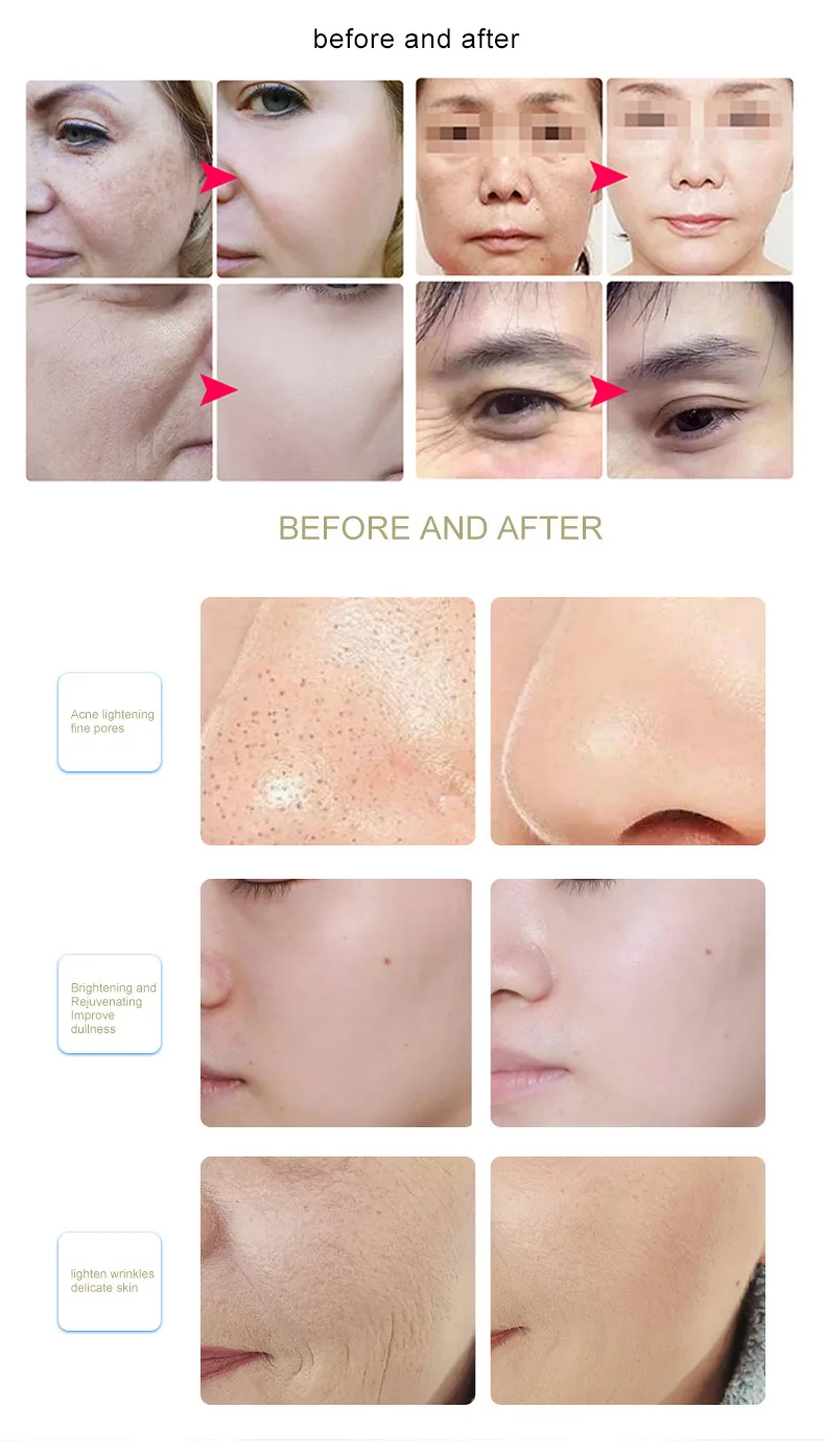 Blue Light Therapy for Skin Cancer