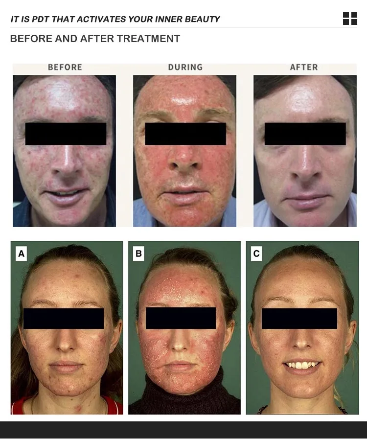 is red light therapy safe for cancer patients